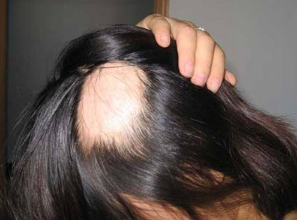 女性斑秃发生的原因