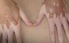白癜风患者如何调节身体好