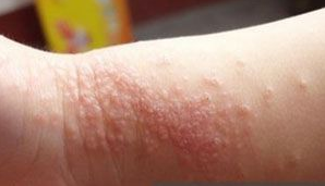 青少年湿疹患者怎样治疗疾病