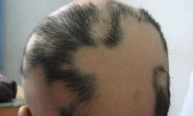 斑秃可以治疗好么