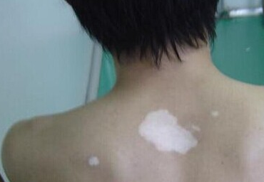 白癜风发病有哪些征兆