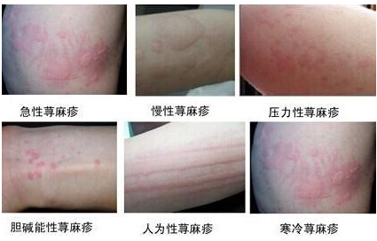 治疗荨麻疹效果明显的方法