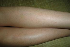 鱼鳞病有何症状特点