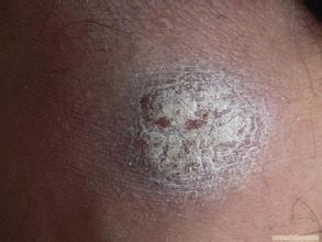 如何快速根除牛皮癣