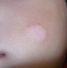 面对白癜风，我们如何破之