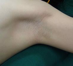 如何快速摆脱腋臭