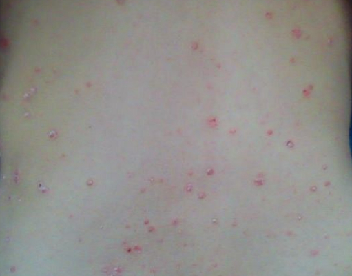 女性牛皮癣患者治疗误区