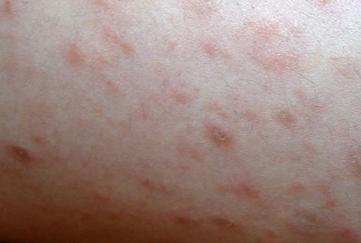 牛皮癣怎么才能好