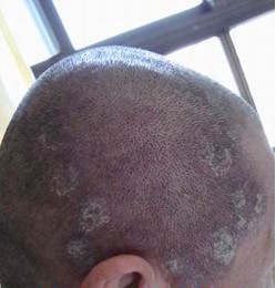 银屑病怎么治疗好