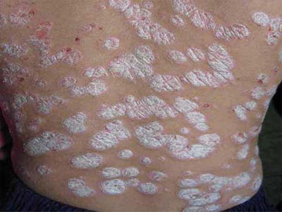 怎么治疗牛皮癣