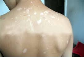 关于白癜风的一些常识