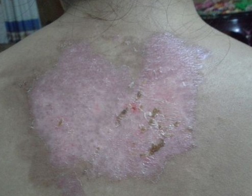 白癜风患者的洗浴注意事项有哪些