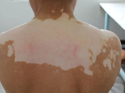 白癜风保健护理常识