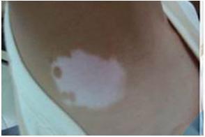 白癜风病因容易被患者忽视的有哪些