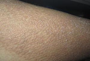 牛皮癣为什么恶化