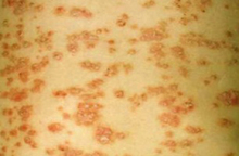 导致牛皮癣发作的原因