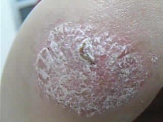 引起牛皮癣的原因是什么