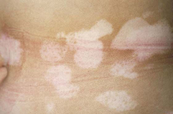 白癜风病因是什么呢