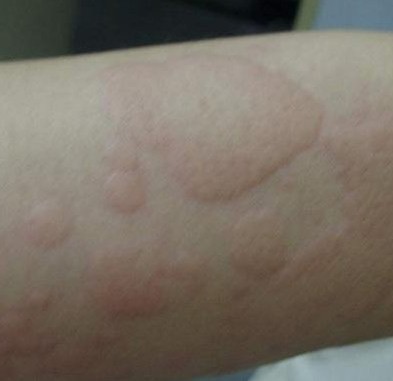 女大学生患荨麻疹全身红痒 影响学习生活